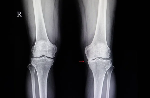 Imagen Rayos Rodilla Izquierda Paciente Con Osteoartritis Degenerativa Con Dolor — Foto de Stock