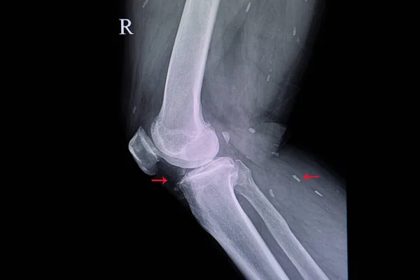 Imagen Rayos Rodillas Con Osteoartritis Degenativa Cisticercosis Calcificada Tejidos Blandos — Foto de Stock