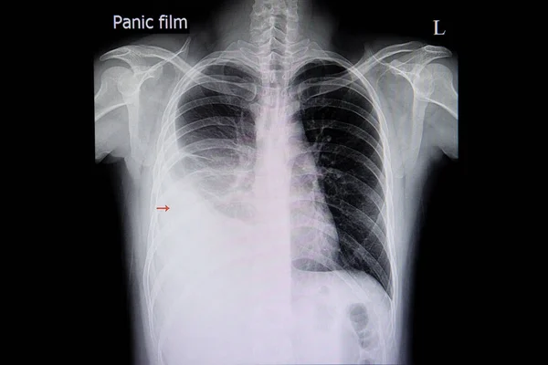Una Radiografía Tórax Paciente Con Derrame Pleural Del Pulmón Derecho — Foto de Stock