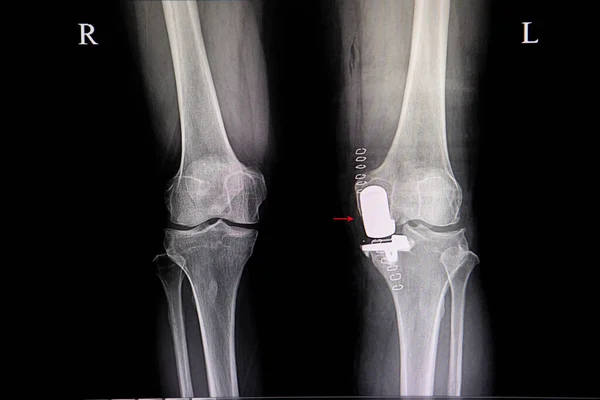 Imagen Rayos Rodilla Izquierda Paciente Con Osteoartritis Degenerativa Muestra Después — Foto de Stock