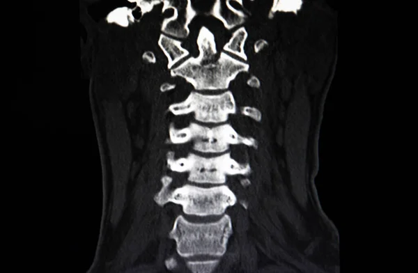 CT scan image of  fracture C2 cervical vertebrae.