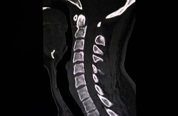 骨折のCtスキャン画像C2子宮頸椎 — ストック写真