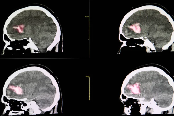 脑出血右额区大血凝块合并血小板增多患者脑的Ct扫描 — 图库照片