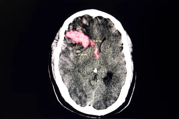 Головного Мозга Тромбоцитопенического Пациента Большим Тромбом Правой Лобной Области Внутримозгового — стоковое фото