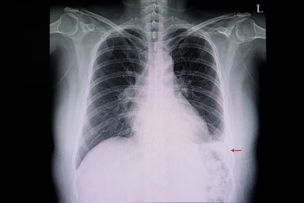 Mellkasröntgenfelvétel Kardiomegáliában Megnagyobbodott Szív Bal Alsó Tüdőgyulladásban Vörös Nyíl Szenvedő — Stock Fotó