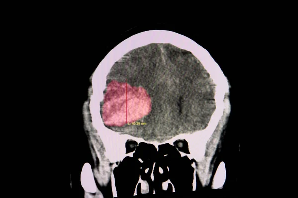 Tomografía Computarizada Del Cerebro Paciente Trombocitopénico Con Coágulo Sanguíneo Grande — Foto de Stock