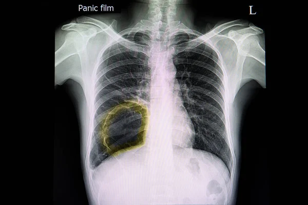 오른쪽 커다란 폐탈색이 환자의 엑스레이 있습니다 노란색 마커는 공동의 윤곽을 — 스톡 사진