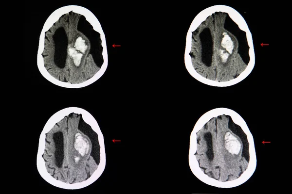 Tomografía Computarizada Del Cerebro Paciente Con Accidente Cerebrovascular Que Muestra — Foto de Stock