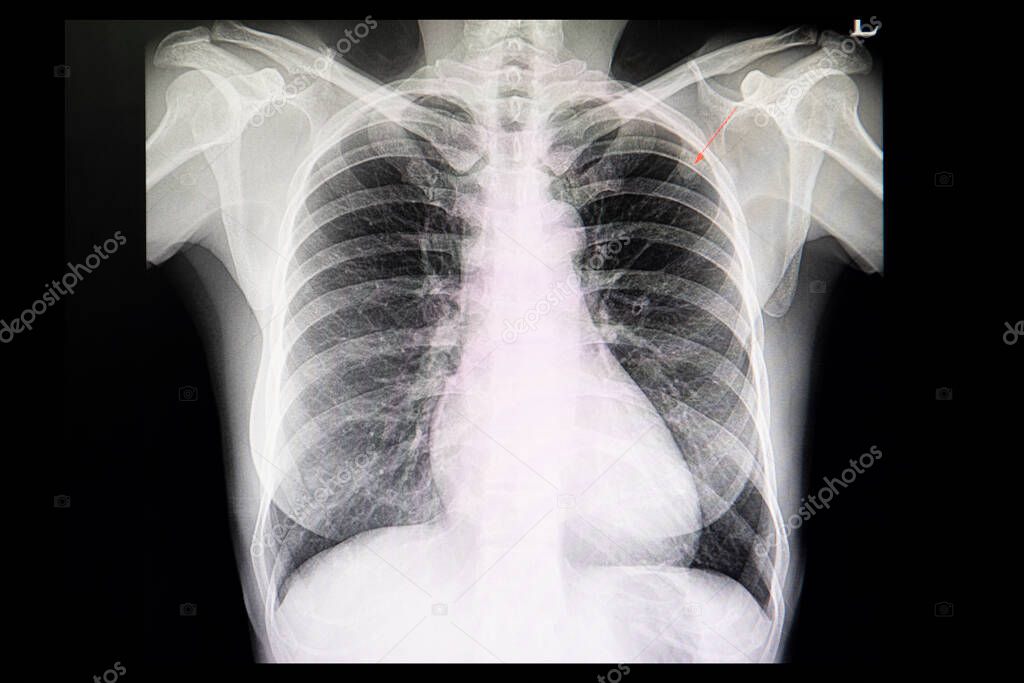 A chest xray film of a patient with lung nodule  in the left upper lung. 