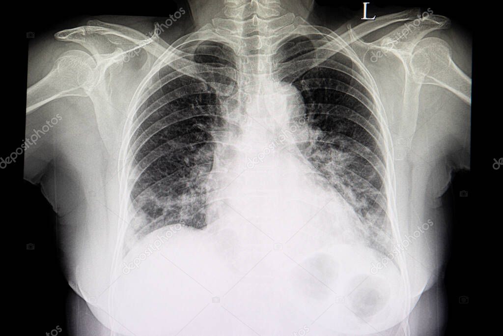 A chest xray film of a patient with cardiomagaly, congestive heart failure and pulmonary edema.
