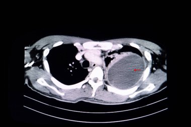 CT scan of the chest of a patient with large loculated pleural effusion in his left thoracic cavity.  Diagnostic findings in patient with dyspnea. Medical education. clipart