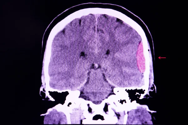 交通意外左半脑硬膜外大出血合并脑水肿的Ct扫描 — 图库照片