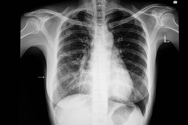 Mellkasröntgenfelvétel Egy Jobb Alsó Tüdőgyulladásos Betegről — Stock Fotó