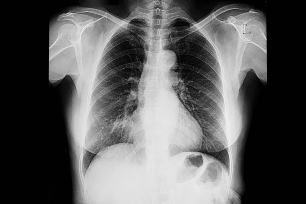 오른쪽 폐폐렴을 환자의 엑스선 — 스톡 사진