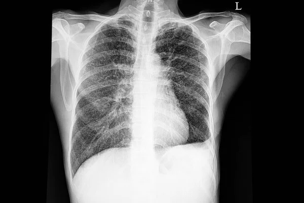 Folia Rentgenowska Klatki Piersiowej Pacjenta Wieloma Małymi Przeniknięciami Guzkowymi Płucach — Zdjęcie stockowe
