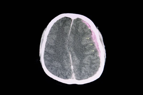 交通意外患者左脑半球大蛛网膜下腔出血合并脑水肿的Ct扫描 — 图库照片