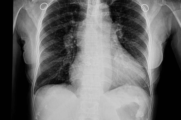 心脏肿大和充血性心力衰竭患者的胸部X线片 — 图库照片
