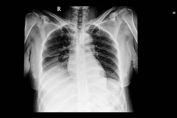 Une Radiographie Pulmonaire Patient Avec Épanchement Pleural Pulmonaire Droit Cathéter — Photo