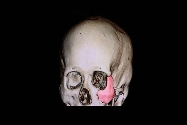 Rendering Skull Patient Traumatic Brain Injury Showing Fracture Left Zygomatic Royalty Free Stock Photos