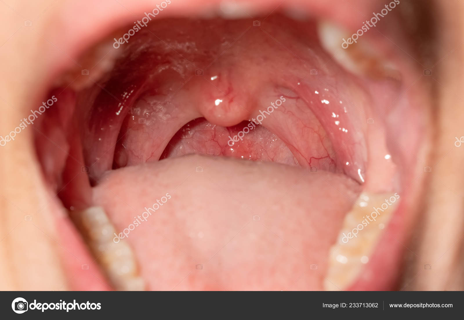 Throat Photos