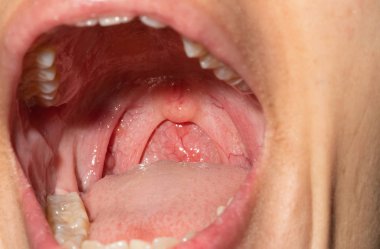 Boğaz ağrısı ile Boğazı şişmiş. Closeup posterior faringeal duvar şişme ve küçük dil ve bademcik ağız açın. Grip köklerinin posterior faringeal duvar. Üst solunum yolu.