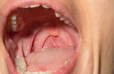 Sore throat with throat swollen. Closeup open mouth with posterior pharyngeal wall swelling and uvula and tonsil. Influenza follicles in the posterior pharyngeal wall. Upper respiratory tract. clipart