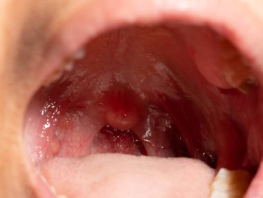 Boğaz ağrısı ile Boğazı şişmiş. Closeup posterior faringeal duvar şişme ve küçük dil ve bademcik ağız açın. Grip köklerinin posterior faringeal duvar. Üst solunum yolu.