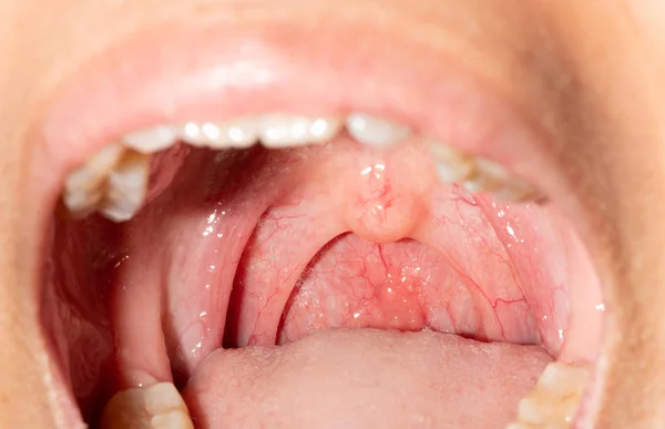 喉の腫れと喉の痛み クローズ アップは 扁桃や口蓋垂咽頭後壁の膨潤と口を開きます インフルエンザ咽頭後壁の卵胞 上気道 — ストック写真