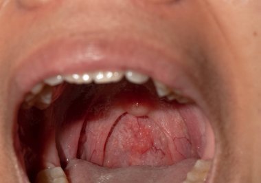Boğaz ağrısı ile Boğazı şişmiş. Closeup posterior faringeal duvar şişme ve küçük dil ve bademcik ağız açın. Grip köklerinin posterior faringeal duvar. Üst solunum yolu.