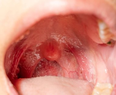 Boğaz ağrısı ile Boğazı şişmiş. Closeup posterior faringeal duvar şişme ve küçük dil ve bademcik ağız açın. Grip köklerinin posterior faringeal duvar. Üst solunum yolu.