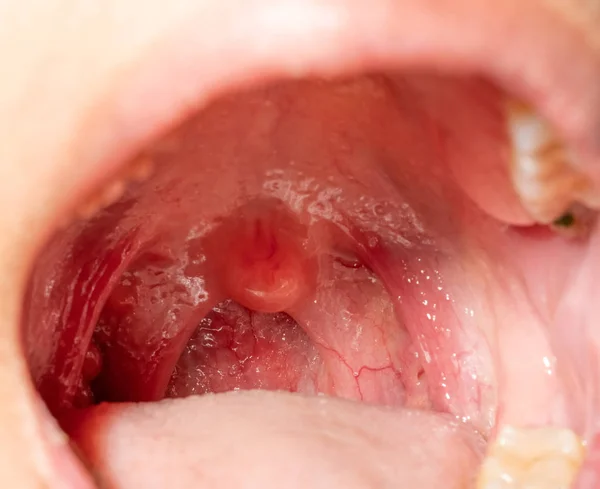 Halsschmerzen mit geschwollenem Hals. Nahaufnahme offener Mund mit Schwellungen der hinteren Rachenwand und Uvula und Mandeln. Grippefollikel in der hinteren Rachenwand. obere Atemwege. — Stockfoto