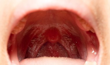 Boğaz ağrısı ile Boğazı şişmiş. Closeup posterior faringeal duvar şişme ve küçük dil ve bademcik ağız açın. Grip köklerinin posterior faringeal duvar. Üst solunum yolu.