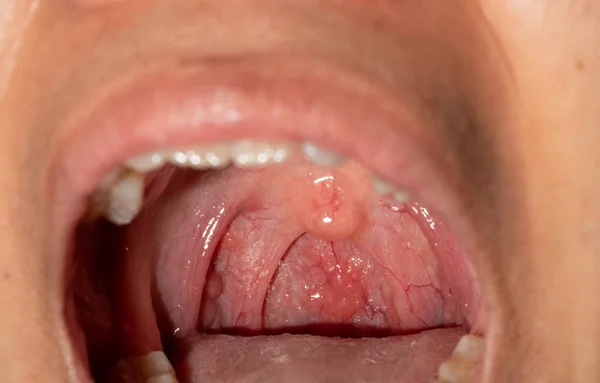 Sore throat with throat swollen. Closeup open mouth with posterior pharyngeal wall swelling and uvula and tonsil. Influenza follicles in the posterior pharyngeal wall. Upper respiratory tract. — Stock Photo, Image