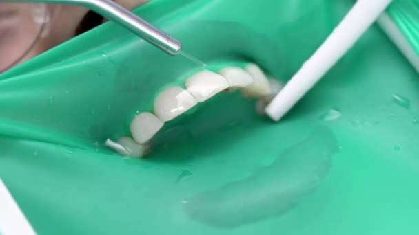 Grazioso trattamento dei denti delle donne in clinica dentale — Video Stock