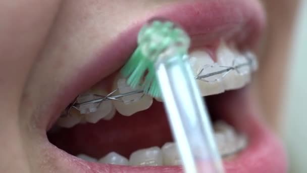 Очистка зубных скобок пациентов в стоматологической клинике — стоковое видео