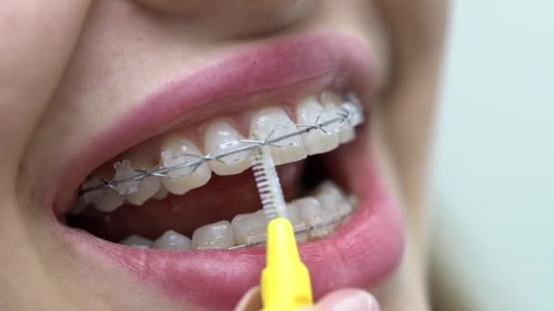 Limpeza de pacientes braquetes de dentes na clínica odontológica — Vídeo de Stock