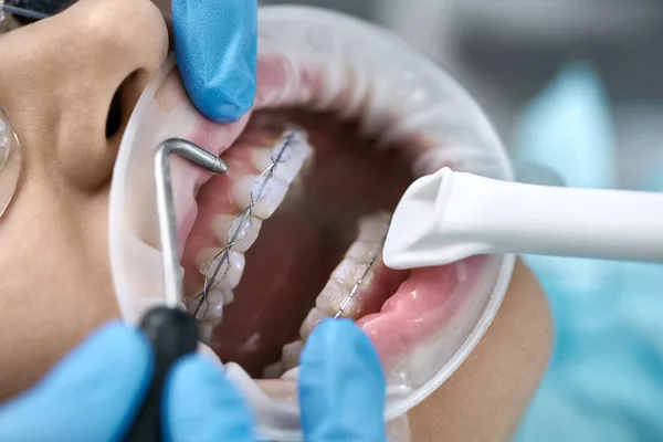 Bonito mulheres limpeza dos dentes na clínica odontológica — Fotografia de Stock