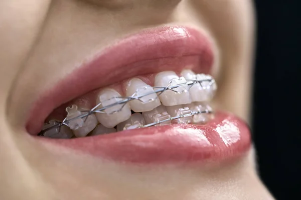 Widok zbliżenia na zęby żeńskie z systemem wspornika — Zdjęcie stockowe