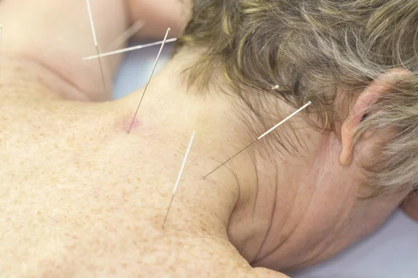 在脂肪水疗中心接受针灸手术的老年妇女 — 图库照片