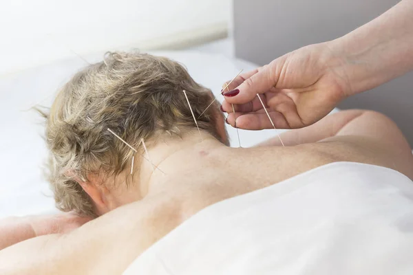 Oudere Vrouw Ondergaat Een Acupunctuur Procedure Een Fat Spa — Stockfoto