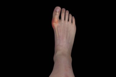 Halluks valgus, ayak hastalığı