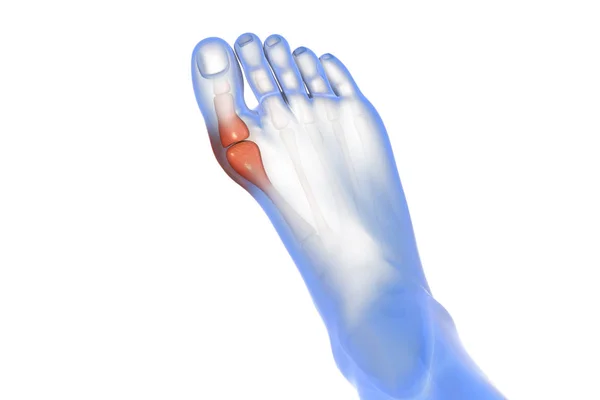 Hallux Valgus Toe Disease — Stock Photo, Image