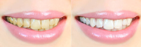 Teeth whitening effect, before and after