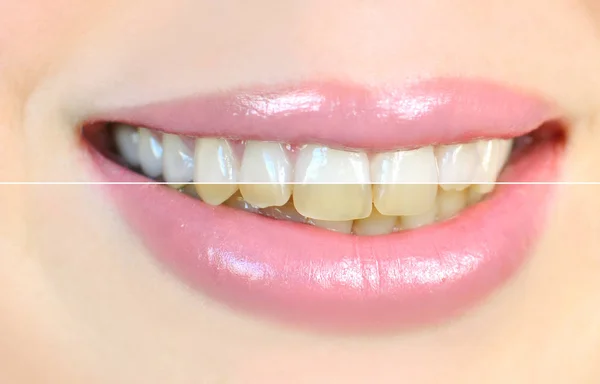 Dentes Branqueamento Efeito Antes Depois — Fotografia de Stock