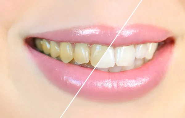 Zębów Wybielanie Efekt Przed — Zdjęcie stockowe