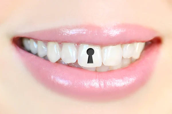 Koncepcja Próchnicy Zębem Otworem Klucz Doskonałym Uśmiechem — Zdjęcie stockowe