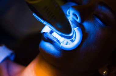 Diş beyazlatma yapan bir diş kliniğinde bir kadının yüzü .