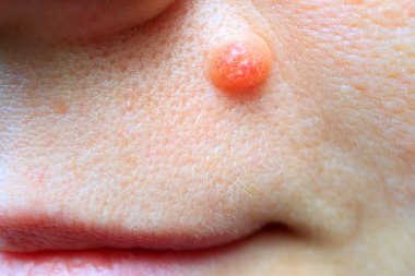 Köstebek tubercle bir kusur yüz cilt üzerinde olan kadının yüzüne