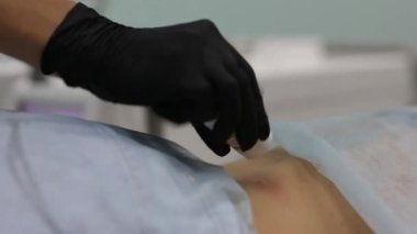 Kozmetik salonda benign tümör çıkarılması. Dermatolojide sıvı azot kullanımı.