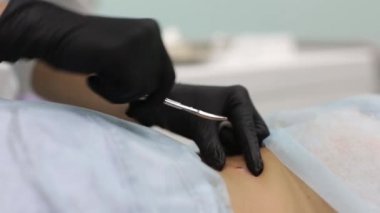 Kozmetik salonda benign tümör çıkarılması. Dermatolojide sıvı azot kullanımı.